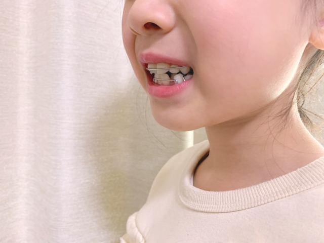 噛み合わせ（咬合）治療